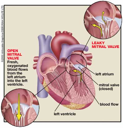  graphic of mitral valve